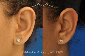 Photo of a patient before and after a procedure. Earlobe Reduction Surgery - Otoplasty procedure to shorten and reshape elongated, hanging earlobes for a more balanced and natural appearance.
