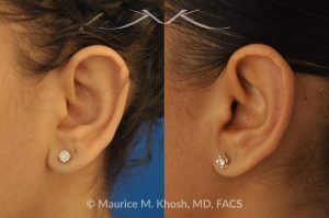 Photo of a patient before and after a procedure. Earlobe Reduction Surgery - Otoplasty procedure to shorten and reshape elongated, hanging earlobes for a more balanced and natural appearance.