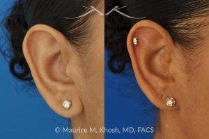 Photo of a patient before and after a procedure. Earlobe Reduction Surgery - Otoplasty procedure to shorten and reshape elongated, hanging earlobes for a more balanced and natural appearance.