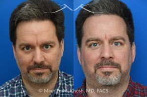 Photo of a patient before and after a procedure. Endoscopic Forehead Lipoma Removal - This patient presented with a subtle, 1-inch diameter bump in the center of the forehead caused by a lipoma—a benign fatty tumor. The mass was removed endoscopically through a concealed hairline incision, leaving no visible scarring and restoring a smooth forehead contour.