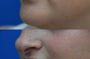 Photo of a patient before and after a procedure. Lip Augmentation with HA Filler - Before and after photo showing improved fullness and symmetry of the lips.