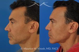 Photo of a patient before and after a procedure. Repair nasal valve obstruction revision rhinoplasty - This gentleman had previously undergone two rhinoplasty operations over 15 years ago. His nasal tip was pinched and obstructing his breathing, Cadaver rib cartilage was used to strengthen and support his external nasal valve. The nasal tip was slightly elevated.