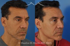 Photo of a patient before and after a procedure. Repair nasal valve obstruction revision rhinoplasty - This gentleman had previously undergone two rhinoplasty operations over 15 years ago. His nasal tip was pinched and obstructing his breathing, Cadaver rib cartilage was used to strengthen and support his external nasal valve. The nasal tip was slightly elevated.