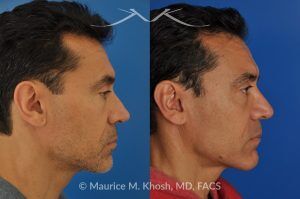 Photo of a patient before and after a procedure. Repair nasal valve obstruction revision rhinoplasty - This gentleman had previously undergone two rhinoplasty operations over 15 years ago. His nasal tip was pinched and obstructing his breathing, Cadaver rib cartilage was used to strengthen and support his external nasal valve. The nasal tip was slightly elevated.