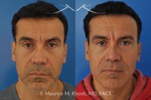 Photo of a patient before and after a procedure. Repair nasal valve obstruction revision rhinoplasty - This gentleman had previously undergone two rhinoplasty operations over 15 years ago. His nasal tip was pinched and obstructing his breathing, Cadaver rib cartilage was used to strengthen and support his external nasal valve. The nasal tip was slightly elevated.