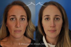 Photo of a patient before and after a procedure. Rhinoplasty to address a bulbous droopy and asymmetric nasal tip - before-and-after composite photo.