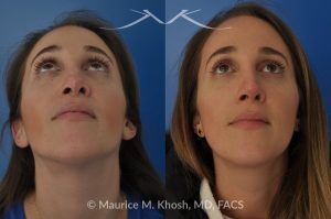 Photo of a patient before and after a procedure. Rhinoplasty to address a bulbous droopy and asymmetric nasal tip - before-and-after composite photo.
