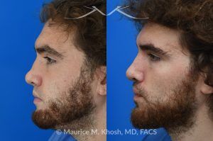 Photo of a patient before and after a procedure. Revision rhinoplasty with ear cartilage graft and osteotomies - This 26 year-old had previously undergone rhinoplasty which resulted in over-resection of the nasal bridge and excess width of the bony nasal dorsum. He underwent revision rhinoplasty in Manhattan by us. Ear cartilage was used to augment the height of the nasal bridge. The nasal bones were broken and moved closer to each other, to narrow the bridge. He is ecstatic with his revision rhinoplasty results. 