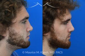 Photo of a patient before and after a procedure. Revision rhinoplasty with ear cartilage graft and osteotomies - This 26 year-old had previously undergone rhinoplasty which resulted in over-resection of the nasal bridge and excess width of the bony nasal dorsum. He underwent revision rhinoplasty in Manhattan by us. Ear cartilage was used to augment the height of the nasal bridge. The nasal bones were broken and moved closer to each other, to narrow the bridge. He is ecstatic with his revision rhinoplasty results. 