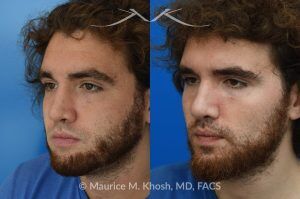 Photo of a patient before and after a procedure. Revision rhinoplasty with ear cartilage graft and osteotomies - This 26 year-old had previously undergone rhinoplasty which resulted in over-resection of the nasal bridge and excess width of the bony nasal dorsum. He underwent revision rhinoplasty in Manhattan by us. Ear cartilage was used to augment the height of the nasal bridge. The nasal bones were broken and moved closer to each other, to narrow the bridge. He is ecstatic with his revision rhinoplasty results. 