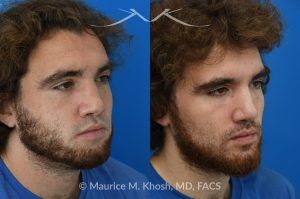Photo of a patient before and after a procedure. Revision rhinoplasty with ear cartilage graft and osteotomies - This 26 year-old had previously undergone rhinoplasty which resulted in over-resection of the nasal bridge and excess width of the bony nasal dorsum. He underwent revision rhinoplasty in Manhattan by us. Ear cartilage was used to augment the height of the nasal bridge. The nasal bones were broken and moved closer to each other, to narrow the bridge. He is ecstatic with his revision rhinoplasty results. 