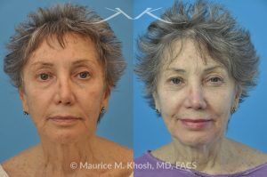 Photo of a patient before and after a procedure. Revision rhinoplasty with rib cartilage graft - This lovely patient had undergone rhinoplasty in her 30′s. She disliked the appearance of her nose and had difficulty breathing from the right side of her nose. She underwent revision rhinoplasty with rib cartilage graft to improve her nasal tip definition and improve her breathing function. The profile picture  with three images shows her nasal appearance before her original surgery, followed by her pre and post operative results after revision rhinoplasty. 