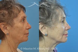 Photo of a patient before and after a procedure. Revision rhinoplasty with rib cartilage graft - This lovely patient had undergone rhinoplasty in her 30′s. She disliked the appearance of her nose and had difficulty breathing from the right side of her nose. She underwent revision rhinoplasty with rib cartilage graft to improve her nasal tip definition and improve her breathing function. The profile picture  with three images shows her nasal appearance before her original surgery, followed by her pre and post operative results after revision rhinoplasty. 