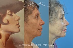Photo of a patient before and after a procedure. Revision rhinoplasty with rib cartilage graft - This lovely patient had undergone rhinoplasty in her 30′s. She disliked the appearance of her nose and had difficulty breathing from the right side of her nose. She underwent revision rhinoplasty with rib cartilage graft to improve her nasal tip definition and improve her breathing function. The profile picture  with three images shows her nasal appearance before her original surgery, followed by her pre and post operative results after revision rhinoplasty. 