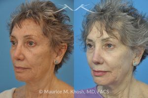 Photo of a patient before and after a procedure. Revision rhinoplasty with rib cartilage graft - This lovely patient had undergone rhinoplasty in her 30′s. She disliked the appearance of her nose and had difficulty breathing from the right side of her nose. She underwent revision rhinoplasty with rib cartilage graft to improve her nasal tip definition and improve her breathing function. The profile picture  with three images shows her nasal appearance before her original surgery, followed by her pre and post operative results after revision rhinoplasty. 