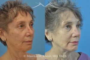 Photo of a patient before and after a procedure. Revision rhinoplasty with rib cartilage graft - This lovely patient had undergone rhinoplasty in her 30′s. She disliked the appearance of her nose and had difficulty breathing from the right side of her nose. She underwent revision rhinoplasty with rib cartilage graft to improve her nasal tip definition and improve her breathing function. The profile picture  with three images shows her nasal appearance before her original surgery, followed by her pre and post operative results after revision rhinoplasty. 