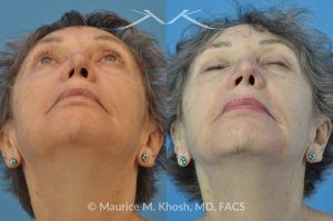 Photo of a patient before and after a procedure. Revision rhinoplasty with rib cartilage graft - This lovely patient had undergone rhinoplasty in her 30′s. She disliked the appearance of her nose and had difficulty breathing from the right side of her nose. She underwent revision rhinoplasty with rib cartilage graft to improve her nasal tip definition and improve her breathing function. The profile picture  with three images shows her nasal appearance before her original surgery, followed by her pre and post operative results after revision rhinoplasty. 