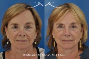 Photo of a patient before and after a procedure. Revison rhinoplasty to straighten a twisted tip - This lovely patient had rhinoplasty many years ago. She had skin cancer removed from the tip of her nose over five years ago. This resulted in a twisted and asymmetric nasal tip. The nasal tip was repaired during an open revision rhinoplasty, utilizing rib cartilage grafts.