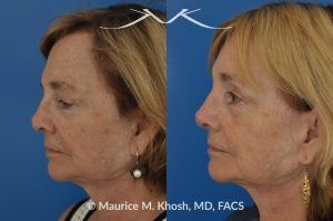 Photo of a patient before and after a procedure. Revison rhinoplasty to straighten a twisted tip - This lovely patient had rhinoplasty many years ago. She had skin cancer removed from the tip of her nose over five years ago. This resulted in a twisted and asymmetric nasal tip. The nasal tip was repaired during an open revision rhinoplasty, utilizing rib cartilage grafts.