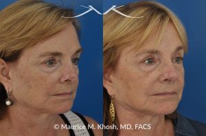 Photo of a patient before and after a procedure. Revison rhinoplasty to straighten a twisted tip - This lovely patient had rhinoplasty many years ago. She had skin cancer removed from the tip of her nose over five years ago. This resulted in a twisted and asymmetric nasal tip. The nasal tip was repaired during an open revision rhinoplasty, utilizing rib cartilage grafts.