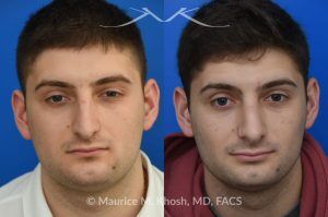 Photo of a patient before and after a procedure. Rhinoplasty for Nasal Obstruction and Aesthetic Correction - This patient's main complaint was bilateral severe nasal obstruction. His secondary concern was the dorsal hump and droopy nasal tip. We used an open rhinoplasty approach to straighten his deviated septum, lower the dorsal hump and place bilateral spreader grafts to widen the internal nasal valve to enhance his breathing. The nasal tip was reduced in size and rotated to achieve the desired tip position.