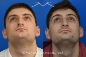Photo of a patient before and after a procedure. Rhinoplasty for Nasal Obstruction and Aesthetic Correction - This patient's main complaint was bilateral severe nasal obstruction. His secondary concern was the dorsal hump and droopy nasal tip. We used an open rhinoplasty approach to straighten his deviated septum, lower the dorsal hump and place bilateral spreader grafts to widen the internal nasal valve to enhance his breathing. The nasal tip was reduced in size and rotated to achieve the desired tip position.