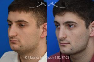 Photo of a patient before and after a procedure. Rhinoplasty for Nasal Obstruction and Aesthetic Correction - This patient's main complaint was bilateral severe nasal obstruction. His secondary concern was the dorsal hump and droopy nasal tip. We used an open rhinoplasty approach to straighten his deviated septum, lower the dorsal hump and place bilateral spreader grafts to widen the internal nasal valve to enhance his breathing. The nasal tip was reduced in size and rotated to achieve the desired tip position.