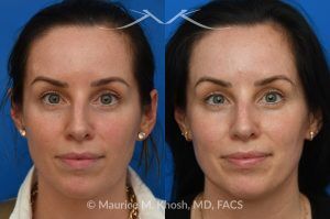 Photo of a patient before and after a procedure. Forehead Osteoma Removal With Hidden Hairline Incision - A visible bump above the patient’s right eyebrow was caused by a forehead osteoma. It was removed through a concealed incision in the hairline, leaving no visible scar and a smooth result.