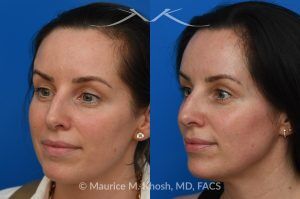 Photo of a patient before and after a procedure. Forehead Osteoma Removal With Hidden Hairline Incision - A visible bump above the patient’s right eyebrow was caused by a forehead osteoma. It was removed through a concealed incision in the hairline, leaving no visible scar and a smooth result.