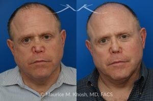 Photo of a patient before and after a procedure. One-Year Results of Saddle Nose Reconstruction Using Rib Cartilage Graft - One-year follow-up photos demonstrate the results of saddle nose reconstruction using the patient’s own rib cartilage. The patient had suffered a severe nasal injury that led to collapse of the nasal bridge, right nostril, and a large septal perforation. In the operating room, rib cartilage was harvested to reconstruct and support the nasal bridge and tip. A delicate graft was also placed to restore the structure of the collapsed right nostril.