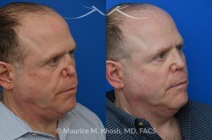 Photo of a patient before and after a procedure. One-Year Results of Saddle Nose Reconstruction Using Rib Cartilage Graft - One-year follow-up photos demonstrate the results of saddle nose reconstruction using the patient’s own rib cartilage. The patient had suffered a severe nasal injury that led to collapse of the nasal bridge, right nostril, and a large septal perforation. In the operating room, rib cartilage was harvested to reconstruct and support the nasal bridge and tip. A delicate graft was also placed to restore the structure of the collapsed right nostril.