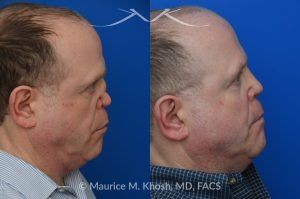 Photo of a patient before and after a procedure. One-Year Results of Saddle Nose Reconstruction Using Rib Cartilage Graft - One-year follow-up photos demonstrate the results of saddle nose reconstruction using the patient’s own rib cartilage. The patient had suffered a severe nasal injury that led to collapse of the nasal bridge, right nostril, and a large septal perforation. In the operating room, rib cartilage was harvested to reconstruct and support the nasal bridge and tip. A delicate graft was also placed to restore the structure of the collapsed right nostril.