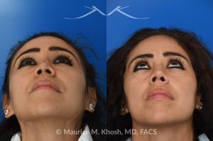 Photo of a patient before and after a procedure. Saddle nose rhinoplasty - This patient had previously undergone an unsuccessful rhinoplasty surgery with cadaver rib cartilage graft. She had developed a saddle collapse of her nose and loss of nasal tip definition. Her own rib and temporalis fascia was used to reconstruct the nose. She is ecstatic with her results at 6 months post op. 