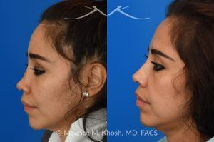 Photo of a patient before and after a procedure. Saddle nose rhinoplasty - This patient had previously undergone an unsuccessful rhinoplasty surgery with cadaver rib cartilage graft. She had developed a saddle collapse of her nose and loss of nasal tip definition. Her own rib and temporalis fascia was used to reconstruct the nose. She is ecstatic with her results at 6 months post op. 