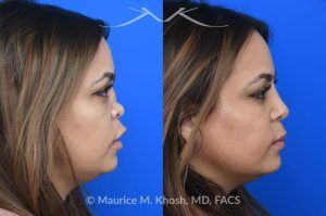 Photo of a patient before and after a procedure. Saddle Nose Repair with Rib Cartilage and Alloderm Graft - This lovely patient had developed saddle collapse of the nose, over-rotation of the nasal tip, and severe nasal obstruction, associated with a septum perforation. In the operating room, a segment of her rib was used to create cartilage grafts to augment the dorsum, and support the nasal tip. A shield graft was fashioned to enhance her nasal tip. Alloderm graft was applied above the dorsal cartilage graft, under the skin. Internal nasal scar tissue was released to further improve breathing. 