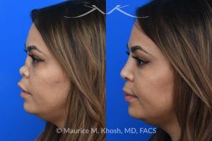 Photo of a patient before and after a procedure. Saddle Nose Repair with Rib Cartilage and Alloderm Graft - This lovely patient had developed saddle collapse of the nose, over-rotation of the nasal tip, and severe nasal obstruction, associated with a septum perforation. In the operating room, a segment of her rib was used to create cartilage grafts to augment the dorsum, and support the nasal tip. A shield graft was fashioned to enhance her nasal tip. Alloderm graft was applied above the dorsal cartilage graft, under the skin. Internal nasal scar tissue was released to further improve breathing. 