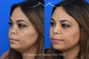 Photo of a patient before and after a procedure. Saddle Nose Repair with Rib Cartilage and Alloderm Graft - This lovely patient had developed saddle collapse of the nose, over-rotation of the nasal tip, and severe nasal obstruction, associated with a septum perforation. In the operating room, a segment of her rib was used to create cartilage grafts to augment the dorsum, and support the nasal tip. A shield graft was fashioned to enhance her nasal tip. Alloderm graft was applied above the dorsal cartilage graft, under the skin. Internal nasal scar tissue was released to further improve breathing. 