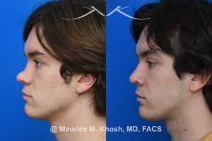 Photo of a patient before and after a procedure. Saddle Nose Repair with Rib Cartilage - Saddle nose collapse in this young patient was repaired with his own rib cartilage. Surgery not only improved his nasal deformity, it also enhanced his breathing capacity. 