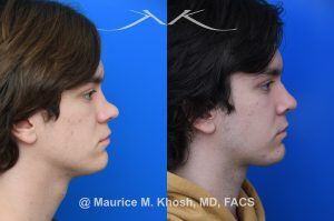 Photo of a patient before and after a procedure. Saddle Nose Repair with Rib Cartilage - Saddle nose collapse in this young patient was repaired with his own rib cartilage. Surgery not only improved his nasal deformity, it also enhanced his breathing capacity. 