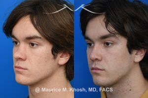 Photo of a patient before and after a procedure. Saddle Nose Repair with Rib Cartilage - Saddle nose collapse in this young patient was repaired with his own rib cartilage. Surgery not only improved his nasal deformity, it also enhanced his breathing capacity. 