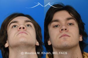 Photo of a patient before and after a procedure. Saddle Nose Repair with Rib Cartilage - Saddle nose collapse in this young patient was repaired with his own rib cartilage. Surgery not only improved his nasal deformity, it also enhanced his breathing capacity. 