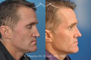 Photo of a patient before and after a procedure. Revision rhinoplasty utilizing rib cartilage - This gentleman who had previously undergone rhinoplasty complained of droopy tip, nose obstruction, and asymmetric appearance of the tip. Revision rhinoplasty utilizing rib cartilage, performed through the open approach allowed restoration of the nasal tip symmetry, improved breathing, and normal tip position.