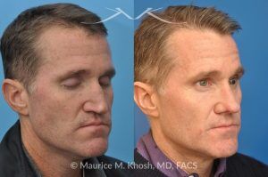 Photo of a patient before and after a procedure. Revision rhinoplasty utilizing rib cartilage - This gentleman who had previously undergone rhinoplasty complained of droopy tip, nose obstruction, and asymmetric appearance of the tip. Revision rhinoplasty utilizing rib cartilage, performed through the open approach allowed restoration of the nasal tip symmetry, improved breathing, and normal tip position.