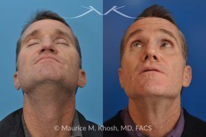 Photo of a patient before and after a procedure. Revision rhinoplasty utilizing rib cartilage - This gentleman who had previously undergone rhinoplasty complained of droopy tip, nose obstruction, and asymmetric appearance of the tip. Revision rhinoplasty utilizing rib cartilage, performed through the open approach allowed restoration of the nasal tip symmetry, improved breathing, and normal tip position.