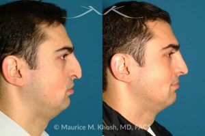 Photo of a patient before and after a procedure. Revision rhinoplasty via an open approach, utilizing cartilage grafts - Patient with cleft lip nasal deformity. Previous rhinoplasty had been unsuccessful at restoring the droopy tip and asymmetric nasal tip. Revision rhinoplasty via an open approach, utilizing cartilage grafts successfully elevated the nasal tip and achieved tip symmetry.