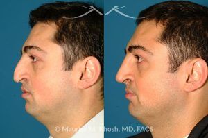 Photo of a patient before and after a procedure. Revision rhinoplasty via an open approach, utilizing cartilage graft - Patient with cleft lip nasal deformity. Previous rhinoplasty had been unsuccessful at restoring the droopy tip and asymmetric nasal tip. Revision rhinoplasty via an open approach, utilizing cartilage grafts successfully elevated the nasal tip and achieved tip symmetry.