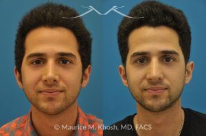 Photo of a patient before and after a procedure. Revision rhinoplasty via the open approach - Previous rhinoplasty in this young man had been a failure. The tip was raised too high, the nose was too short, and the tip was pinched. Revision rhinoplasty via the open approach successfully addressed the abnormalities and rendered the nose more aesthetic and natural in its appearance.