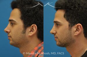 Photo of a patient before and after a procedure. Revision rhinoplasty via the open approach - Previous rhinoplasty in this young man had been a failure. The tip was raised too high, the nose was too short, and the tip was pinched. Revision rhinoplasty via the open approach successfully addressed the abnormalities and rendered the nose more aesthetic and natural in its appearance.