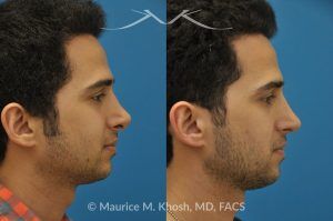 Photo of a patient before and after a procedure. Revision rhinoplasty via the open approach - Previous rhinoplasty in this young man had been a failure. The tip was raised too high, the nose was too short, and the tip was pinched. Revision rhinoplasty via the open approach successfully addressed the abnormalities and rendered the nose more aesthetic and natural in its appearance.