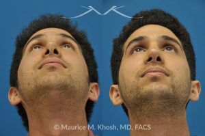 Photo of a patient before and after a procedure. Revision rhinoplasty via the open approach - Previous rhinoplasty in this young man had been a failure. The tip was raised too high, the nose was too short, and the tip was pinched. Revision rhinoplasty via the open approach successfully addressed the abnormalities and rendered the nose more aesthetic and natural in its appearance.